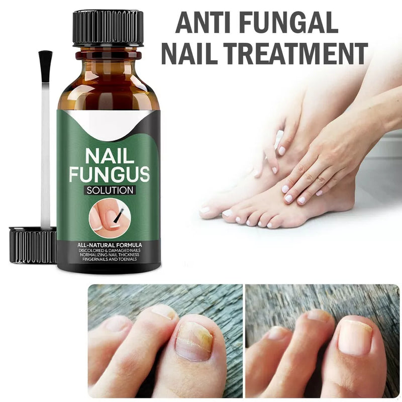 Fingernail Fungus Treatment